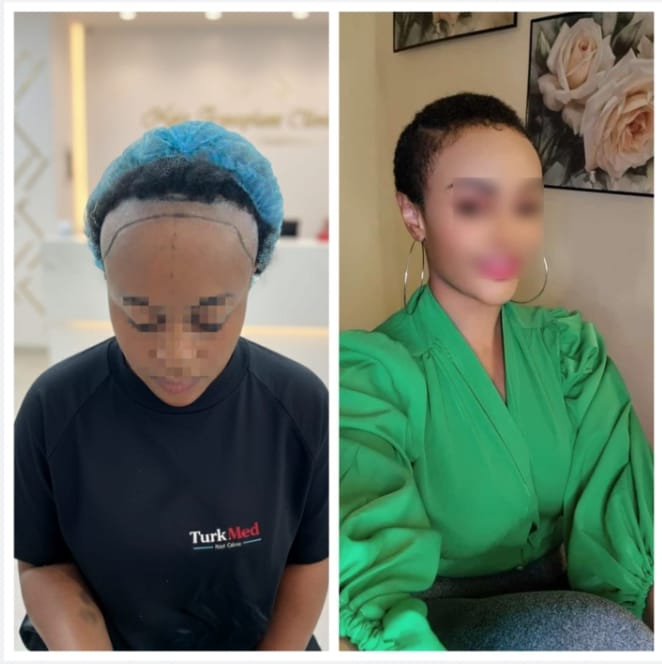 Before Hair Transplant Crown View